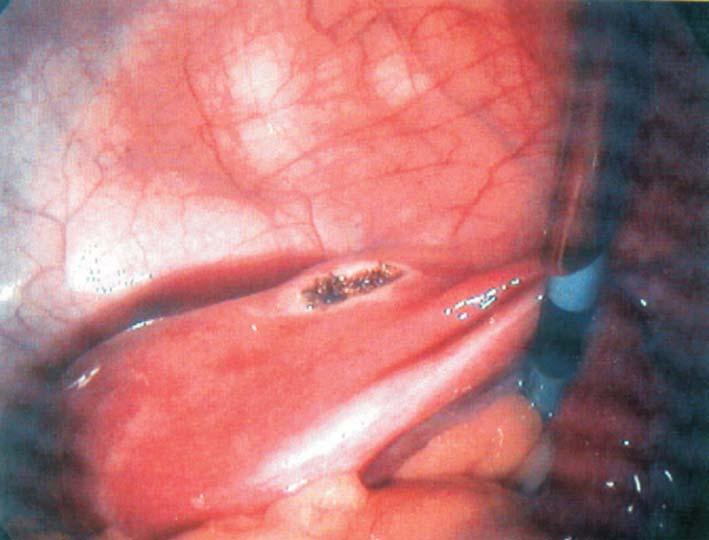 45x28x34mm, endometrium with the breadth of 5mm, an oval thick-walled structure with the dimensions 31x22 mm in the left uterus horn, with the wall thickness at 7,5mm and a liquid content with solid
