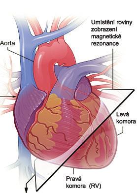 Srdce a MRI Vyšetření pomocí magnetické rezonance řez v krátké ose srdce
