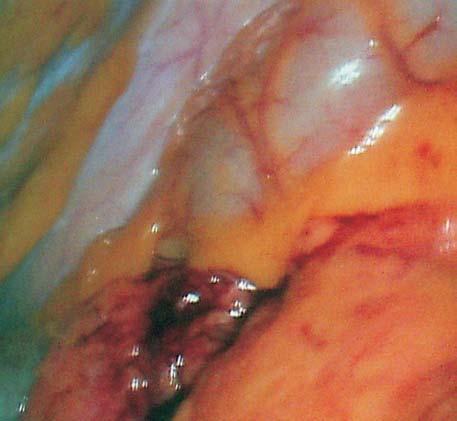Problemy kliniczne związane z założeniem wkładki wewnątrzmacicznej (IUD). Opis przypadku 63 gliwości bólowe pacjentka zgłosiła się do gabinetu ginekologicznego w Opolu.