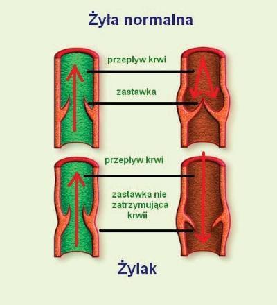 PROCESY ZAKRZEPOWO-ZATOROWE, OPERACJE Z DUŻĄ