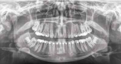 Z kolei w standardowych przypadkach program panoramiczny lub cefalometryczny zapewni odpowiednią jakość zdjęcia RTG.