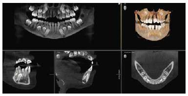 Aparaty RTG Dentsply Sirona 3D umożliwiają pracę w