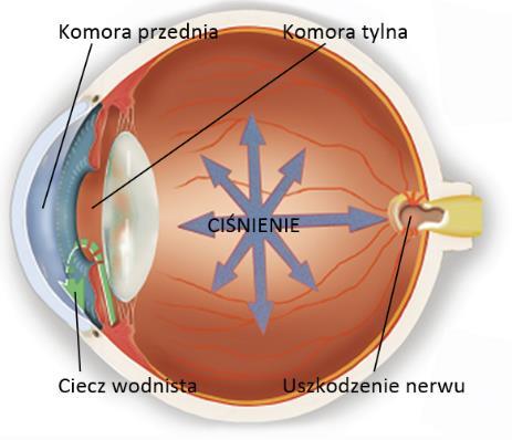 Jaskra 1 Jaskrą nazywana jest grupa chorób oka o charakterze chronicznym i postępującym, w których dochodzi do stopniowego niszczenia nerwu wzrokowego.