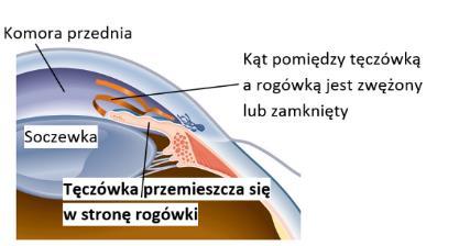 W przypadku jaskry zamykającego się kąta przesączania specyficzna budowa przedniej części oka powoduje, że odpływ cieczy wodnistej jest blokowany przez tęczówkę. Do zaburzenia może dojść np.