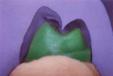 for metal-free aesthetic procedures Isolation of dentures in the flask Matrix for making temporary crowns/bridges ADVANTAGES Smooth surface Very high heat resistance (above 200 C)