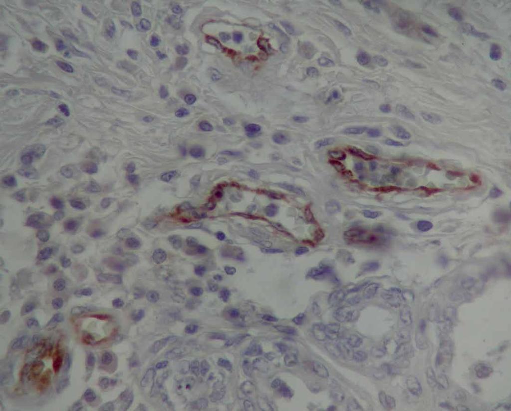 Przypuszcza się, że rozwój guzów i przerzutów ma miejsce wówczas, kiedy zostanie zniesiona aktywność inhibitorów angiogenezy. Drugi mechanizm jest związany z powstaniem fenotypu angiogennego (tzw.