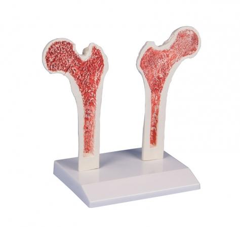 Porównawczy model kości udowej: Kość zdrowa / Kość osteoporotyczna Nr ref: MA01212 Informacja o produkcie: Porównawczy model kości
