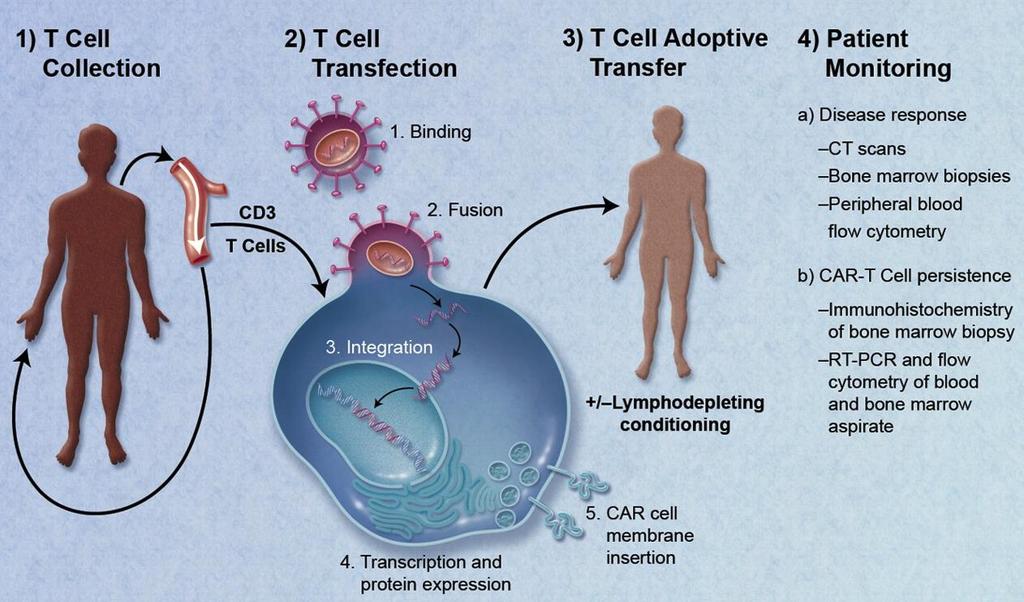 Ostra białaczka limfoblastyczna CAR T cells