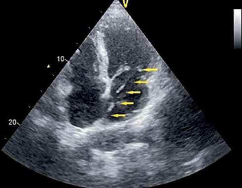 Pocket hematoma Pneumothorax (and pleural hematoma) Venous thrombosis Early dysfunction of the lead Early postoperative infection (local and sepsis) Decubitus of the pocket and threatening decubitus