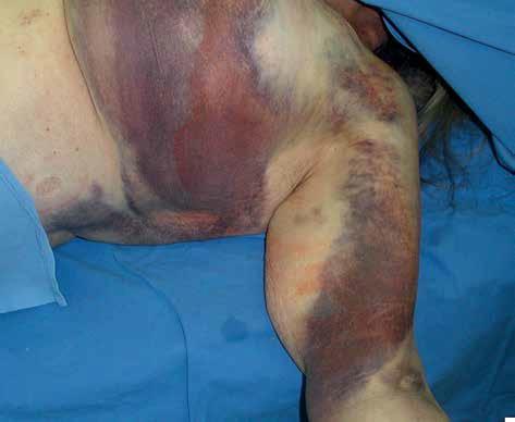 Szymon Domagała et al. Complications of electrotherapy Figure 2. Extensive hematoma after implantation of pacing system ly close location to the pleura [35].