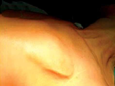 Szymon Domagała et al. Complications of electrotherapy are advanced age, external irritants and insufficient adipose tissue.