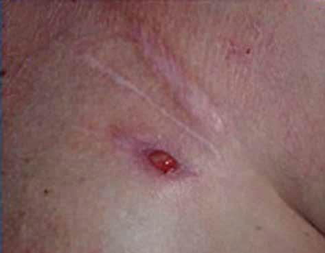Until the moment the skin is tight and immovable, we recognize threatening decubitus (Figures 3 A, B).