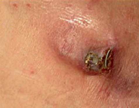 In the case of threatening decubitus the creation of a new pocket of the device in the deeper layers of the tissue, on the pectoralis major or below it, is recommended.
