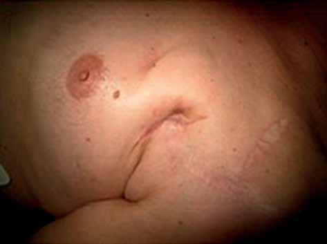 Their actual incidence is difficult to estimate, and ranges from 1% to 14% of all late complications [3, 15].