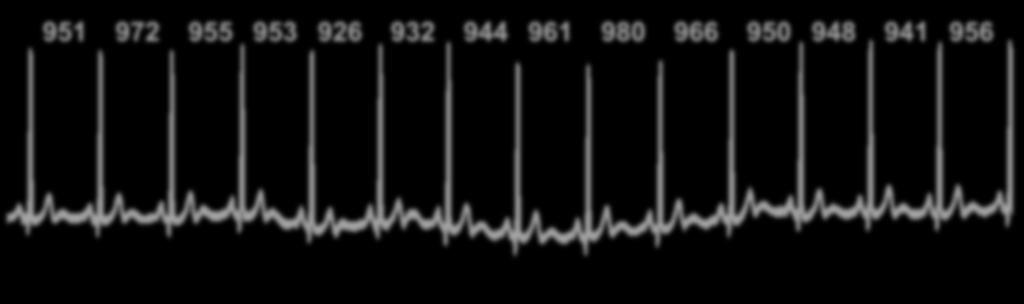 Heart rate variability-