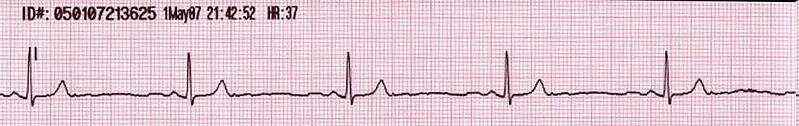 Typowe zaburzenia rytmu serca Bradykardia