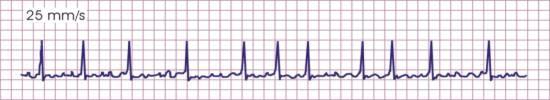 P, przeważnie tachykardią z wąskimi zespołami QRS, arytmią i zachowanym
