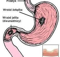 Choroby żołądka