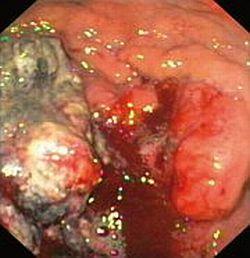 Choroba wrzodowa