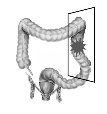 Transversectomia