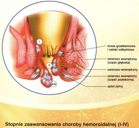 Choroby odbytnicy