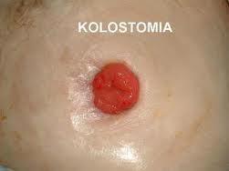 Kolostomia Połączenie