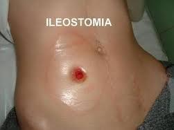 Ileostomia Połączenie