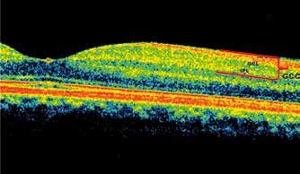 Przydatność różnych metod optycznej koherentnej tomografii w diagnostyce jaskry i ocenie jej progresji Utility of Different Optical Coherence Tomography Methods in Glaucoma Diagnosis and Monitoring