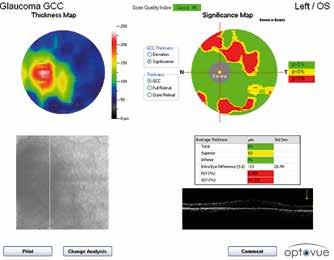 grubości kompleksu komórek zwojowych. Ganglion cells complex loss and accompanying defects in perimetry in a patient with glaucoma.