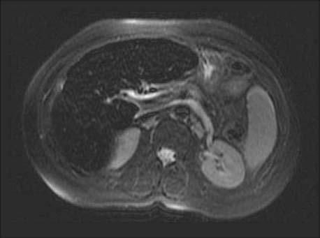 Hemochromatoza 117 wego w sekwencji T2 (ryc. 1.).