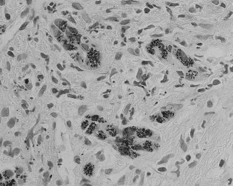 2B, 200 ) oraz w nabłonku przewodzików żółciowych (ryc. 2C, 400 ) Fig. 2. Hepatic histopatology. Nodular reconstruction of hepatic parenchyme with stage III fibrosis.