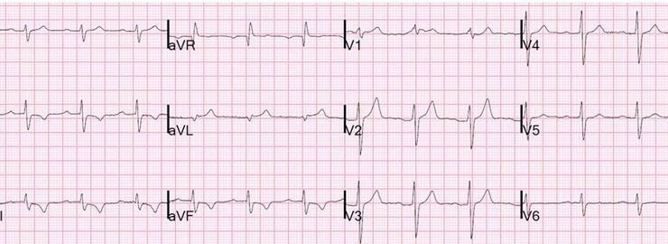 STEMI