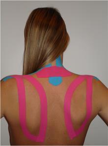Kinesio taping Normalizacja napięcia mięśniowego?