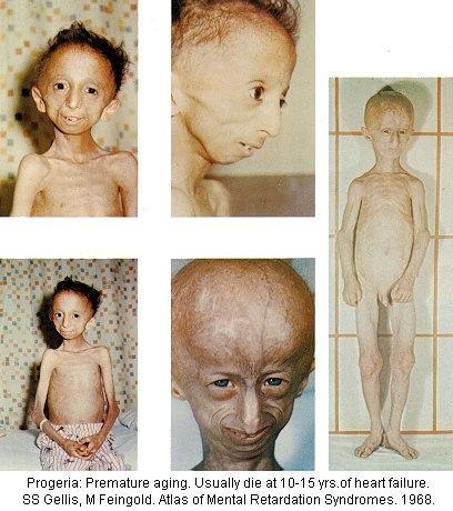 Progeria Hutchinsona-