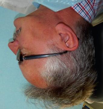 Most z protezą szkieletową in situ (zdjęcie wewnątrzustne). Fig. 9. Patient s profile after implantoprosthetic treatment.