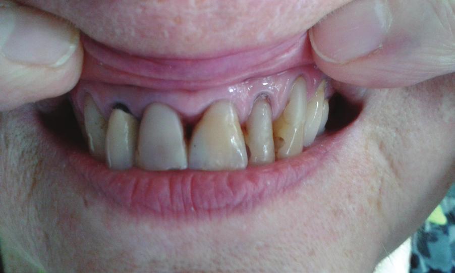 Management of pulp canal obliterations J Stoma 2017; 70, 5 Fig. 1. Photograph of tooth 21. Marked coronal discoloration visible.