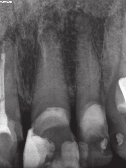 Korona zęba jest ciemniejsza i bardziej żółta niż korona zębów sąsiednich. Fig. 2. Radiograph of tooth 21. No periapical radiolucency is visible. Zdjęcie rentgenowskie zęba 21.
