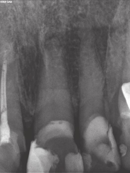 Zdjęcie rentgenowskie zęba 21 wykonane szesnaście lat później. Brak zmian zapalnych w tkankach okołowierzchołkowych. patient was kept under observation and another check-up appointment was made.