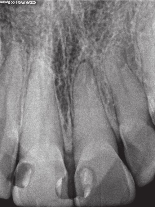 J Stoma 2017; 70, 5 Olczak K., Kabacińska K., Pawlicka H. Fig. 4. Radiograph of tooth 21. The canal lumen is almost invisible. Zdjęcie zęba 21. Światło kanału prawie niewidoczne. Fig. 5. Radiograph of tooth 21 performed after obtaining canal patency.