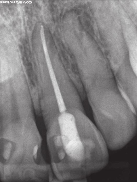 Po zamknięciu ubytku materiałem tymczasowym, wykonano kontrolne zdjęcie rentgenowskie (Fig. 6). Fig. 6. Radiograph of tooth 21 after final obturation.