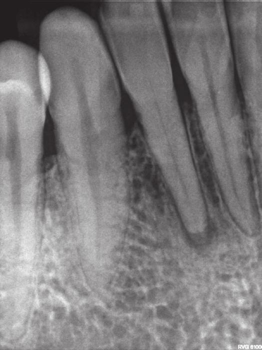 Management of pulp canal obliterations J Stoma 2017; 70, 5 Fig. 7. Radiograph of tooth 42 taken prior to the endodontic treatment.