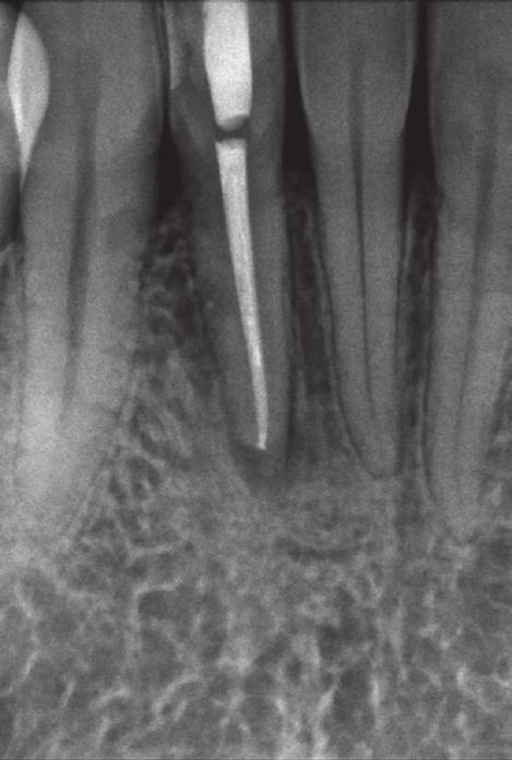 Widoczne przejaśnienie w okolicy wierzchołka korzenia zęba 42 wskazujące na przewlekłe zapalenie tkanek okołowierzchołkowych. Fig. 8. Radiograph of tooth 42 taken directly after canal obturation.