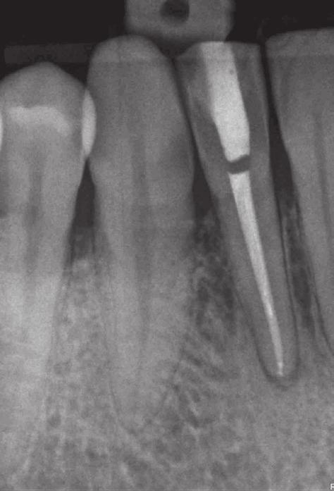 There was no history of pain. Preprocedural radiographic examination revealed chronic granulomatous periapical inflammation and pulp canal obliteration of tooth 42 (Fig. 7).