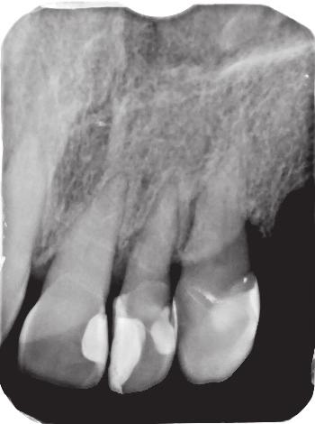 J Stoma 2017; 70, 5 Olczak K., Kabacińska K., Pawlicka H. Fig. 10. Radiograph of teeth 22 and 23 taken prior to the initial endodontic treatment.