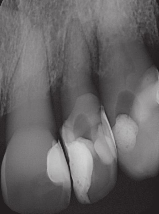 Radiograph of teeth 22 and 23 taken in the Endodontic Clinic before undertaking root canal treatment. Zdjęcie zębowe zębów 22, 23 wykonane przed podjęciem leczenia kanałowego w poradni endodoncji.