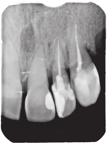 prepared with the step-back technique (MAF=30# WL=21 mm). Finally, the canal was obturated with laterally condensed cold gutta percha and AH Plus sealer.