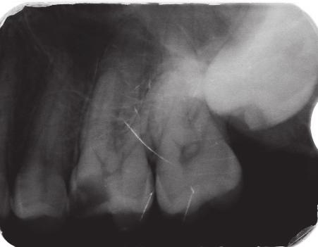 Management of pulp canal obliterations J Stoma 2017; 70, 5 Fig. 13. Radiograph of tooth 26 before treatment. Zdjęcie zębowe zęba 26 przed podjęciem leczenia. Fig. 14.