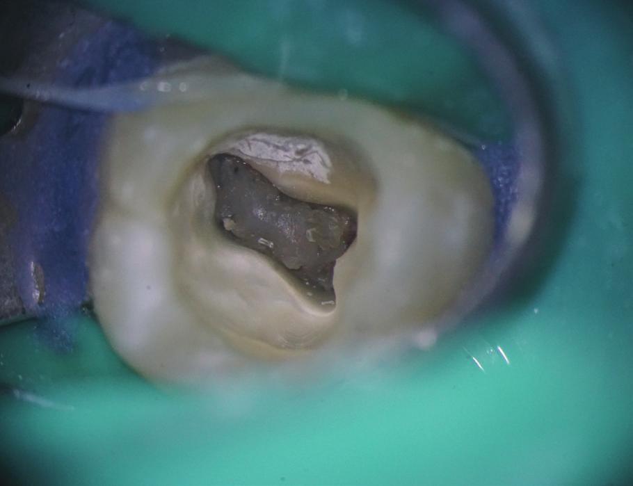 Widoczny zębiniak wypełniający znaczną część jamy zęba. Fig. 15. The denticle that was removed from tooth 26. Coronal and root canal parts of the denticle visible. Zębiniak usunięty z zęba 26.
