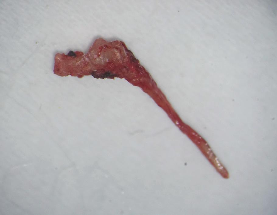 5 A 23-year-old male patient was seen for continuation of endodontic treatment of tooth 26 (Fig. 13).