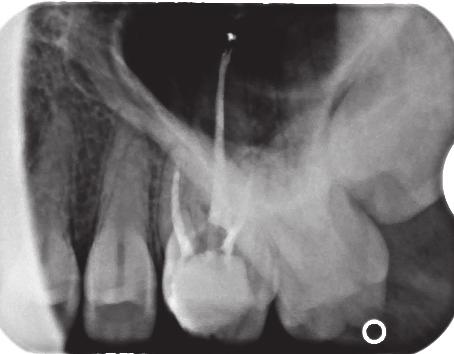 During the previous visit the dentist diagnosed irreversible pulpitis and after opening the tooth and placing a dressing (Dexadent) he referred the patient for further treatment at the Department of